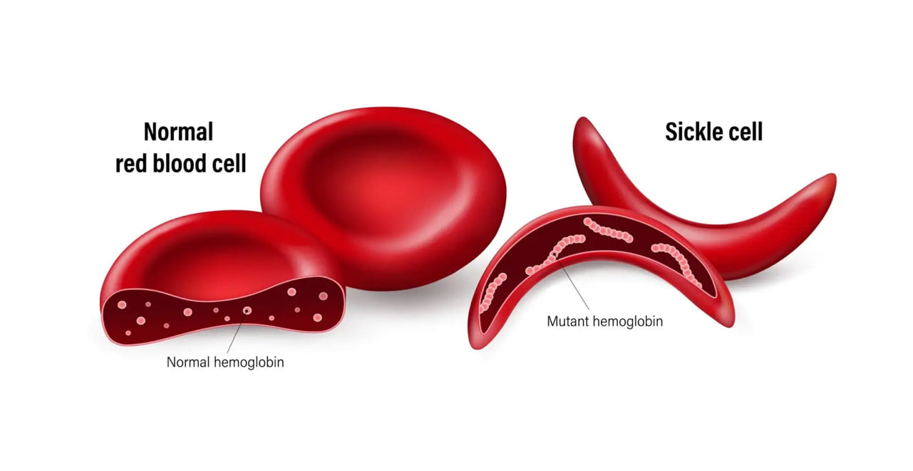 Sickled •Sickle Cell, Sickle Cell Anemia